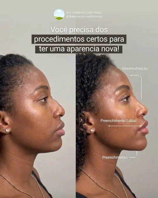 Arte_antes_depois_aparencia_hof_full_face